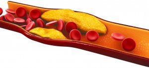 bad cholesterol blood vessels 