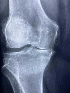 knee pain structure