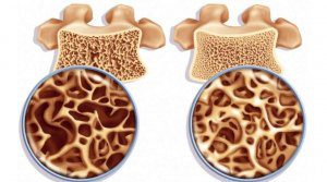 Bone density 